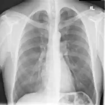 Chest X-Ray image