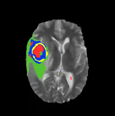 Improved segmentation results after restricting the amount of
