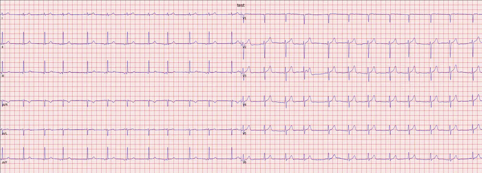 example 12 lead plot