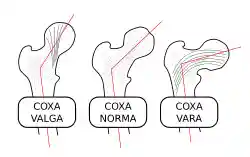 Coxa-valga-norma-vara-000.svg