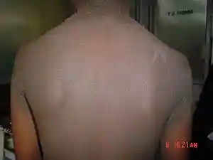 Familial acanthosis nigricans2.jpg