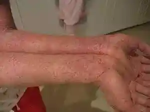 Eczema-arms.jpg