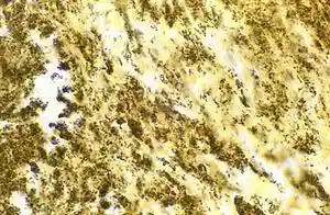 Blood culture negative endocarditis.jpg
