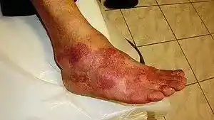 Allergy to Antibiotic Cefaclor.JPG