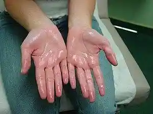 Hyperhidrosis Treatment.jpg