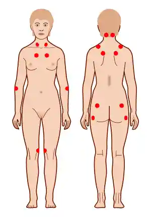 Tender points fibromyalgia.svg