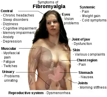 Fibromyalgia symptoms.svg