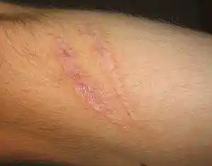 Scar (xndr).jpg