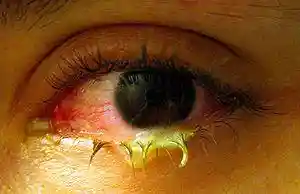 Swollen eye with conjunctivitis.jpg