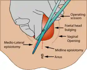 Medio-lateral-episiotomy.gif