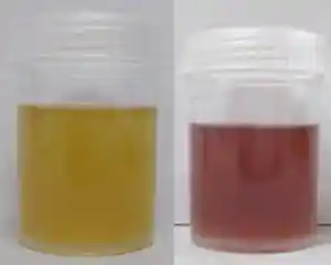 Urine of patient with porphyria.png