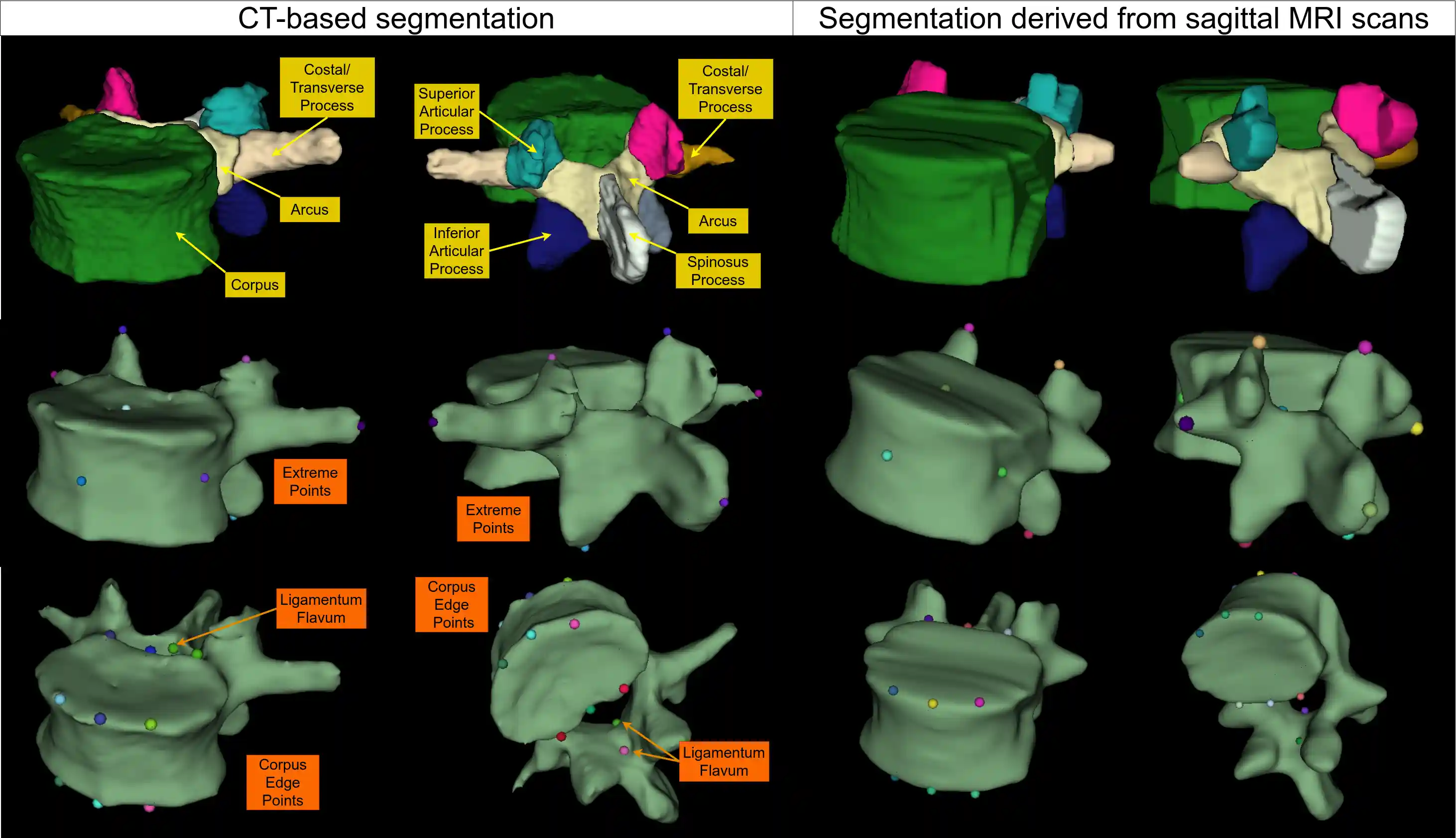 Example of two lumbar vertebrae. The left example is derived from 1 mm isotropic CT, the right from sagittal MRI with a resolution of 3.3 mm in the left–right direction. Top row: Subregion of the vertebra used for analysis. Middle row: Extreme points. Bottom row: Corpus edge and ligamentum flavum points.