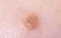 Spitz nevus