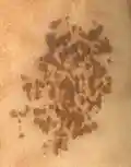 Nevus spilus