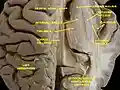 Ventricles of brain and basal ganglia. Superior view. Horizontal section. Deep dissection