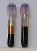 Two tubes of EDTA-anticoagulated blood. Left tube: after standing, the RBCs have settled at the bottom of the tube. Right tube: Freshly drawn blood